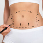 The Best Tummy Tuck Surgery in Texas Guide