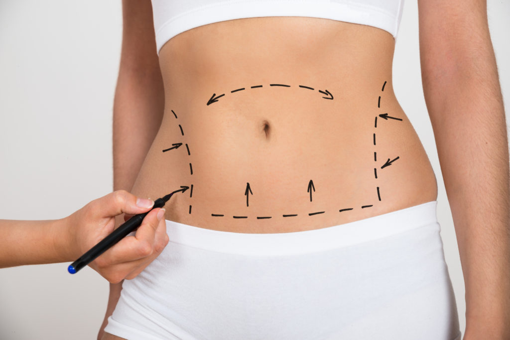 The Best Tummy Tuck Surgery in Texas Guide